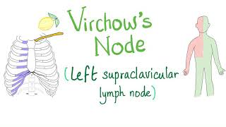 Virchows Node Left Supraclavicular Lymph Node  Cancer  Oncology [upl. by Dnamra]