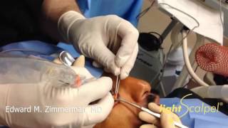 Lower Blepharoplasty Fat Excision  Laser Surgery  Part 2 [upl. by Salahi]