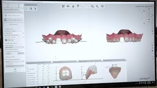 3 reasons to choose 3Shape Indirect Bonding Studio [upl. by Eissim944]