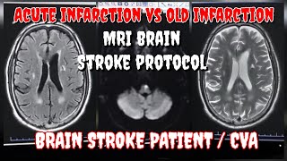 Acute Infarction vs Chronic Infarction Old Lacunar Infarction in MRI Brain  Stroke Patient MRI [upl. by Kcajyllib982]