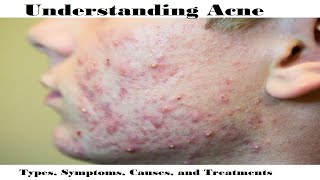 Understanding Acne Types Symptoms Causes and Treatments [upl. by Aihsele]