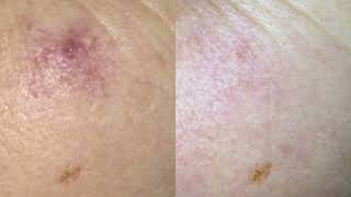 Cherry Angioma removal quick and easy with NDyag laser technology [upl. by Erdnassak]