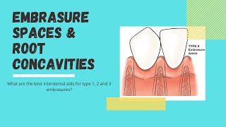 What are embrasure spaces and root concavities Lets look at interdental aids [upl. by Eserehs863]