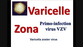 La Varicelle et le zona Chez ladulte les symptomes de la maladie virale des lesions cutanées [upl. by Virginia]