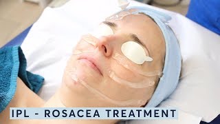 How to treat rosacea  IPL [upl. by Aniuqahs]