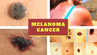 Melanoma Symptoms  Causes Pictures Stages Signs and Symptoms of Melanoma Skin Cancer Tumor [upl. by Shauna944]