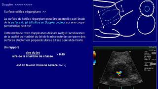 insuffisance aortique [upl. by Aehtorod806]