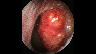 Nasopharyngeal carcinoma [upl. by Ettenej]