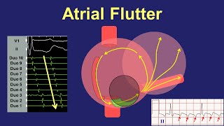 Atrial Flutter  Fundamentals of Diagnosis and Ablation [upl. by Anawait960]