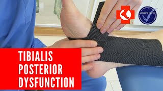 Taping painful TIBIALIS POSTERIOR TENDON [upl. by Adnahsor199]