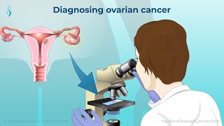 Diagnosing Ovarian Cancer [upl. by Longan]