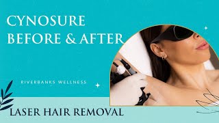 Cynosure Laser Hair Removal Before amp After  What You Need to Know [upl. by Ecnaiva]