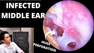 The Worst Ear Infection Suppurative Otitis Media [upl. by Mariana]