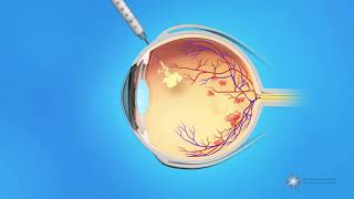 Eye Injections for Central Retinal Vein Occlusion CRVO [upl. by Nollid]