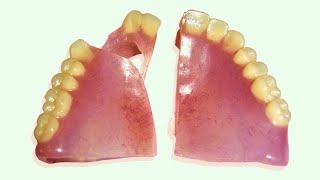 How to Repair a Broken Denture in 25 Minutes [upl. by Wurst]