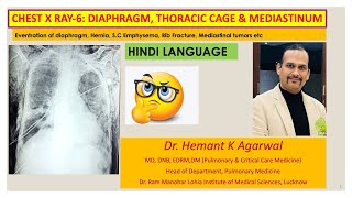 Radiology Chest X Ray6 HINDI Diaphragm Chest wall and MediastinumDr Hemant K Agarwal [upl. by Renae]