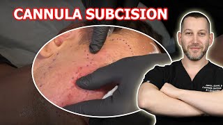 RIP APART ACNE SCARS WITH A CANNULA SUBCISION  Dr Jason Emer [upl. by Xerxes407]