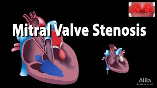 Mitral Valve Stenosis Animation [upl. by Tilden]