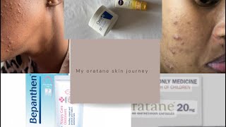 How I cleared my acne with orataneside effectscost amp more oratane cerave nivea [upl. by Nomyad109]