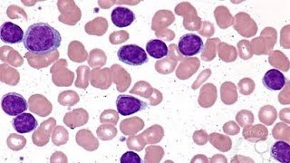 Chronic Lymphocytic Leukemia CLL [upl. by Hamilton]