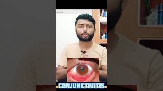 Conjunctivitis  কনজাংটিভাইটিস conjunctivitis conjunctivitistreatment allergicconjunctivitis [upl. by Laehcimaj]