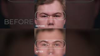 Transformative Upper Eyelid Lift Discover Dr David Stokers Secrets [upl. by Lower]