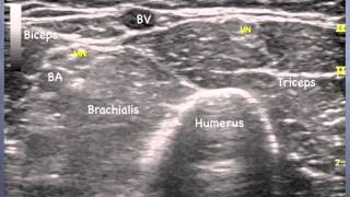 Median Nerve  elbow Sonoanatomy  QMH AED Ultrasound Casebook 2013 Video 10 [upl. by Pegeen]