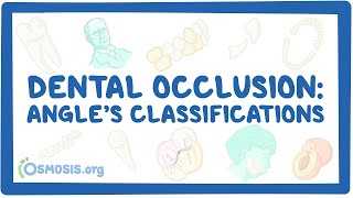 Dental occlusion  Angle’s classifications [upl. by Grath]