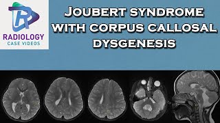 Joubert syndrome with corpus callosal dysgenesis [upl. by Riker247]