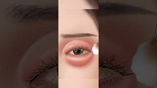 Eyes infection clinging 3D Animation ASMR Video  infected eyes 🤢😷satisfying relaxing shorts [upl. by Nefen]