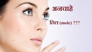 चेहरे से अनचाहे तिल mole को हटाने के घरेलू उपाय  home remedies  mole removal on face [upl. by Kinchen]