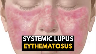 Systemic Lupus Eythematosus SLE Causes Signs and Symptoms Diagnosis and Treatment [upl. by Aicilihp]