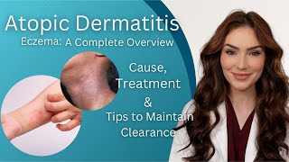 Atopic Dermatitis  Diagnosis Treatment and Maintenance Tips [upl. by Eisset709]