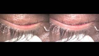 Meibomian gland dysfunctionmanagement with Fugo blade 3D film [upl. by Nonnaehr996]