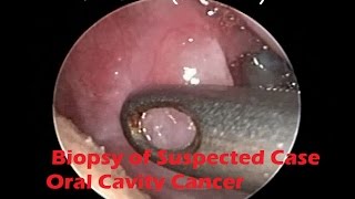 Endoscopic Biopsy of Suspected Case of Oral Cavity Cancer Under LA  SCC [upl. by Aliuqahs]