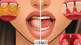 ASMR Get Rid of Bad Breath Tonsil Stone Removal Salivary Glands Cleaning ASMR [upl. by Deeyn]