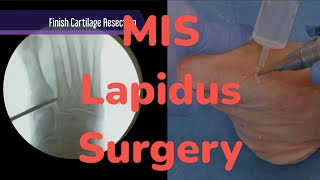 MIS Lapidus Surgery [upl. by Faus]