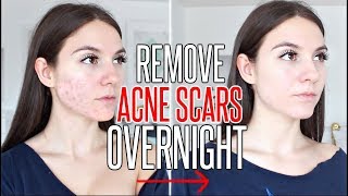 How To Remove Pimples Overnight  Acne Treatment  Anaysa [upl. by Annim]