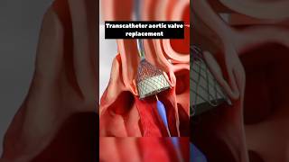 Trans catheter Aortic Valve Replacement [upl. by Adnola]