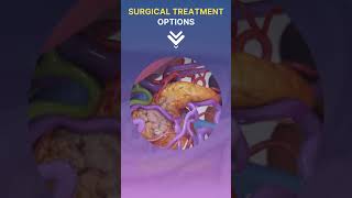 Pancreatic Cancer Treatment amp Prevention Options [upl. by Wiersma]