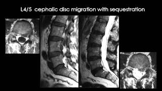 Radiology  Spinal Degenerative disease [upl. by Ahsikit57]