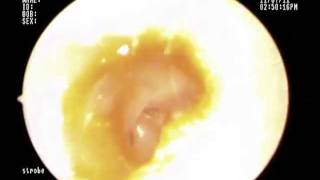 Total Ear Drum Perforation [upl. by Elinor180]