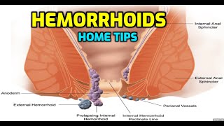 hemorrhoid tips to cure at home Beauty System Online TV [upl. by Etnoid]