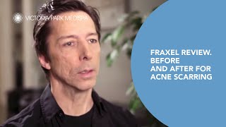 Fraxel Review Before and After for Acne Scarring  Victoria Park [upl. by Enytsirhc543]