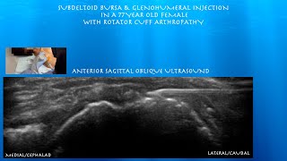 Ultrasound Guided Subdeltoid Bursa Glenohumeral injection in a Female with Rotator Cuff Arthropathy [upl. by Zobias]