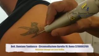 Rimozione tatuaggio Roma con laser Q SWITCHED REVLITE  Dott Tambasco [upl. by Ataga]