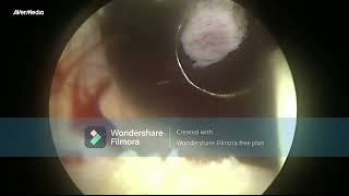 TURP transurethral resection of prostate 80 GM [upl. by Eceerehs]