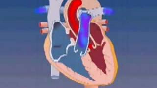 Atrial Septal Defect [upl. by Euqinim229]