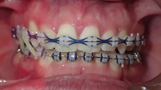 Orthodontic Transformation from Start to Finish [upl. by Elyr373]