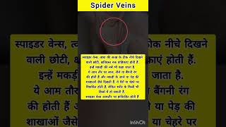 Whats the Spider Veins  healthfacts medicalfacts medicalcondition spiderveins health disease [upl. by Lyndsie314]